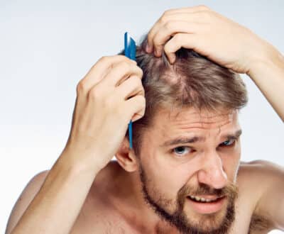 How Testosterone Affects Hair Loss