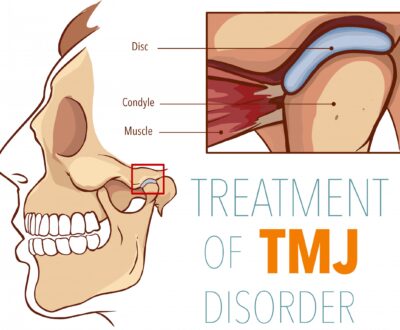 The Role of Dental Night Guards in Preventing TMJ Disorders